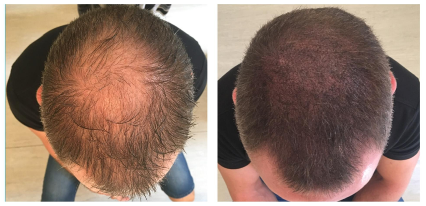 Découvrez la MicroPigmentation capillaire 3D : une solution non-chirurgicale, durable et naturelle contre la calvitie. Résultat immédiat, sans douleur ni cicatrice.